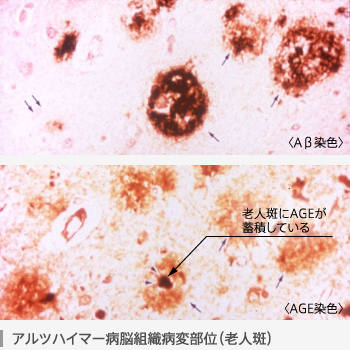 アルツハイマー病脳組織病変部位（老人斑）